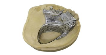 使用金属增材制造工艺打造完美贴合的义齿