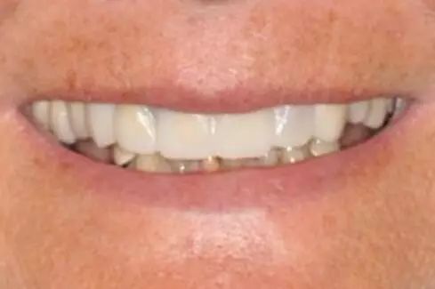 固定义齿修复中暂时修复体的制作方法
